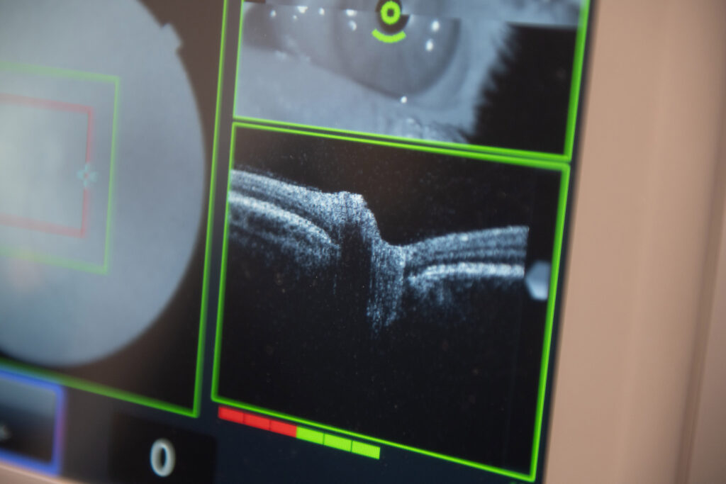 close up of results of a patients OCT scan