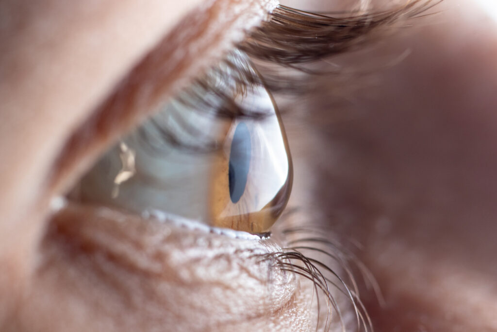 Close up image of a persons eye with astigmatism