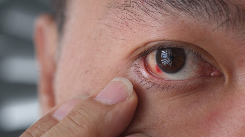 A visual representation of a subconjunctival haemorrhage where the eye appears red. The man is pulling his eyelid down gently to show the problematic eye